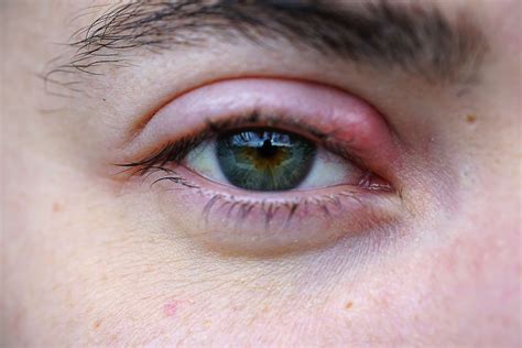 what causes a stye on eyelid